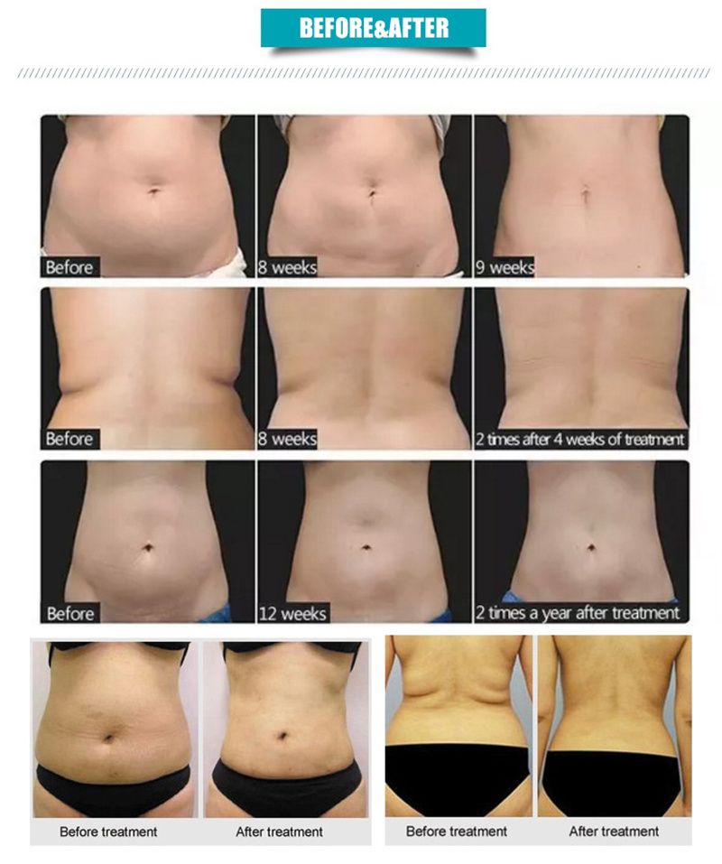 Equipo NEO portátil, máquina de adelgazamiento, celulitis ultrasónica, eliminación de arrugas, Estiramiento facial, 2 asas, máquina reductora de grasa Ultra 360