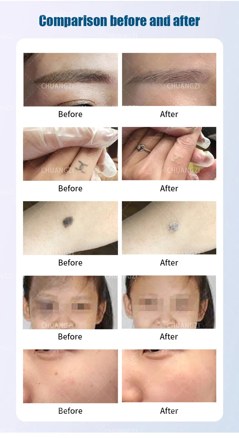 Máquina de Belleza Láser Más Vendida, Láser Portátil Q-switch ND YAG para Eliminación de Tatuajes, Eliminación de Pigmentación, Máquina de Peeling de Carbono